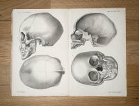 Ett fall af mikrocefali j&auml;mte en kort framst&auml;llning af mikrocefalien i allm&auml;nhet (Med 12 tr&auml;snitt och 2 taflor i litografi)